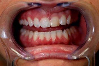 Before bonding procedure